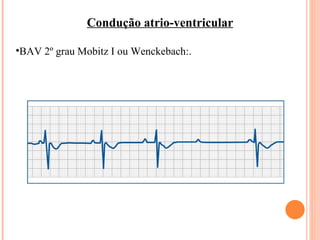 Condução atrio-ventricular BAV 2º grau Mobitz I ou Wenckebach:. 