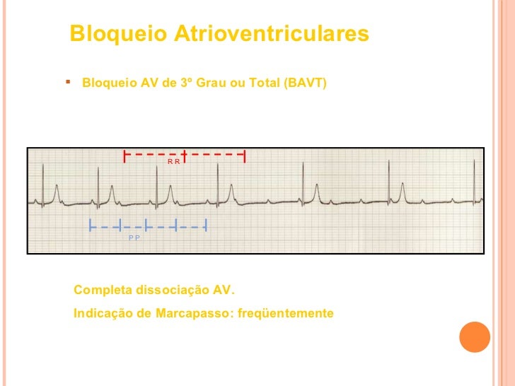 BLOQUEIOS ATRIOVENTRICULARES