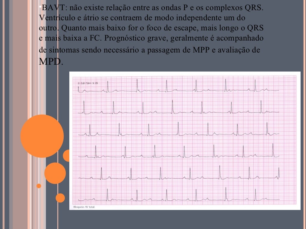 BLOQUEIOS ATRIOVENTRICULARES