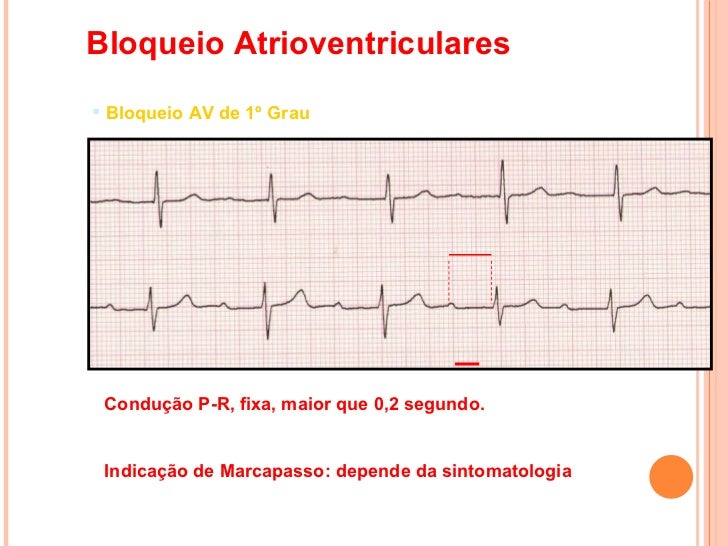 BLOQUEIOS ATRIOVENTRICULARES