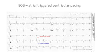 Pacemaker implantation indications
● Benign arrhythmias only in symptomatic patients
○ Sick sinus syndrome
○ 2nd grade AV ...