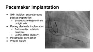 Patient care after pacemaker implantation
● Pacemaker clinic, outpatient
● Pacemaker check-up each 6 to 12 months
○ Batter...