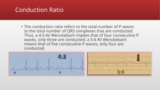 (Brady arrhythmia ) cardcardio 1) (1).pptx