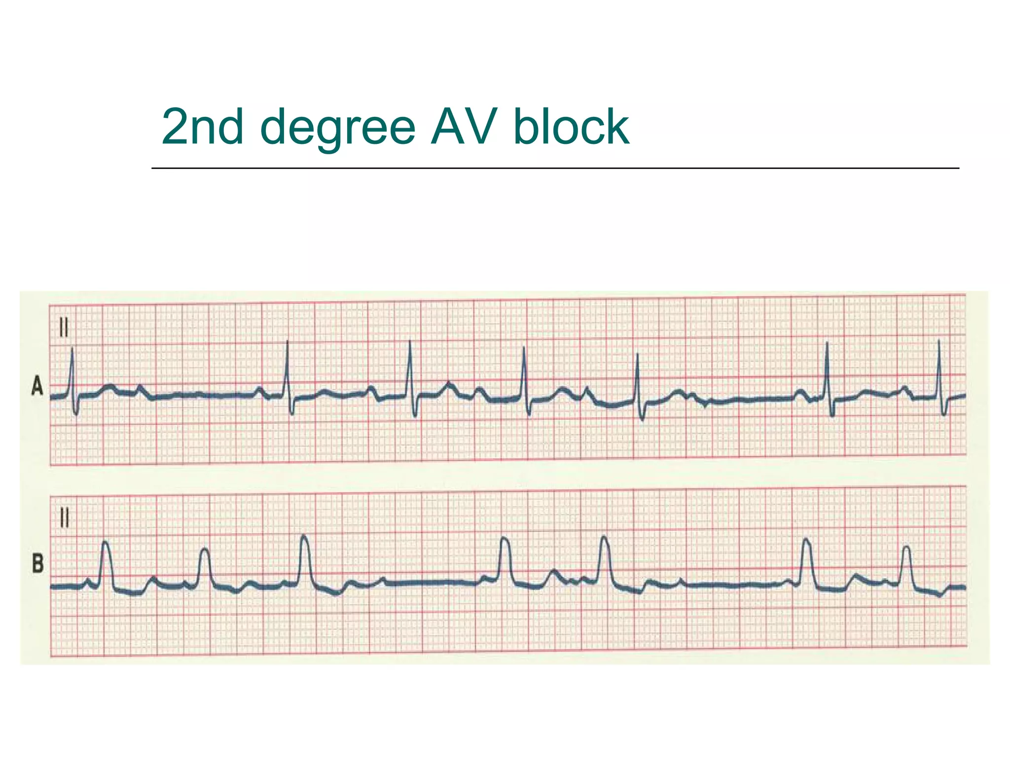 2nd degree AV block 