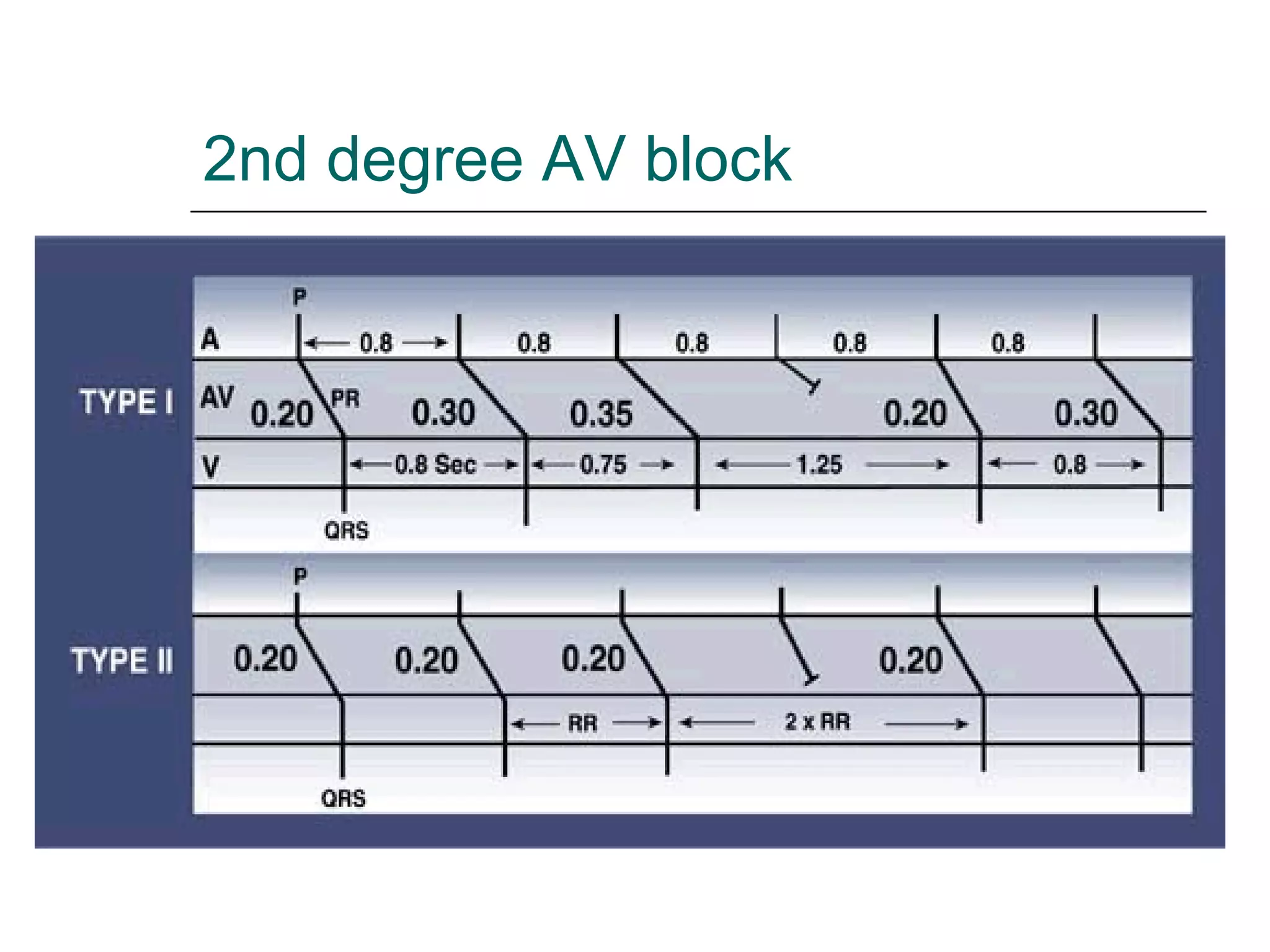 2nd degree AV block 
