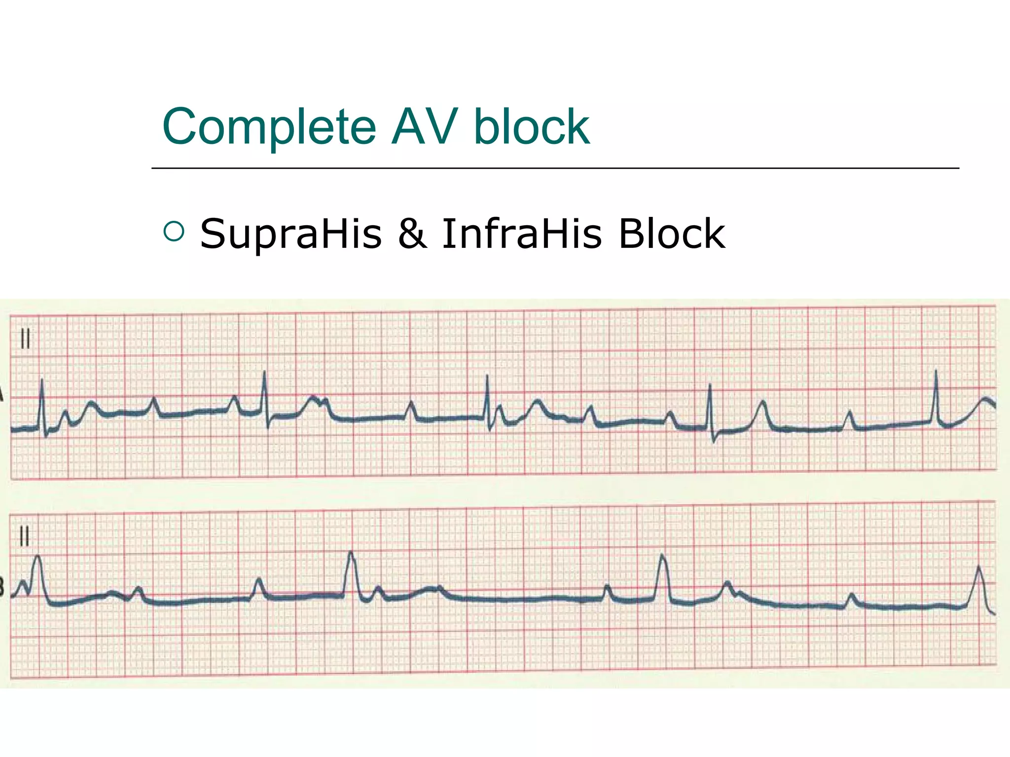 Complete AV block SupraHis & InfraHis Block 