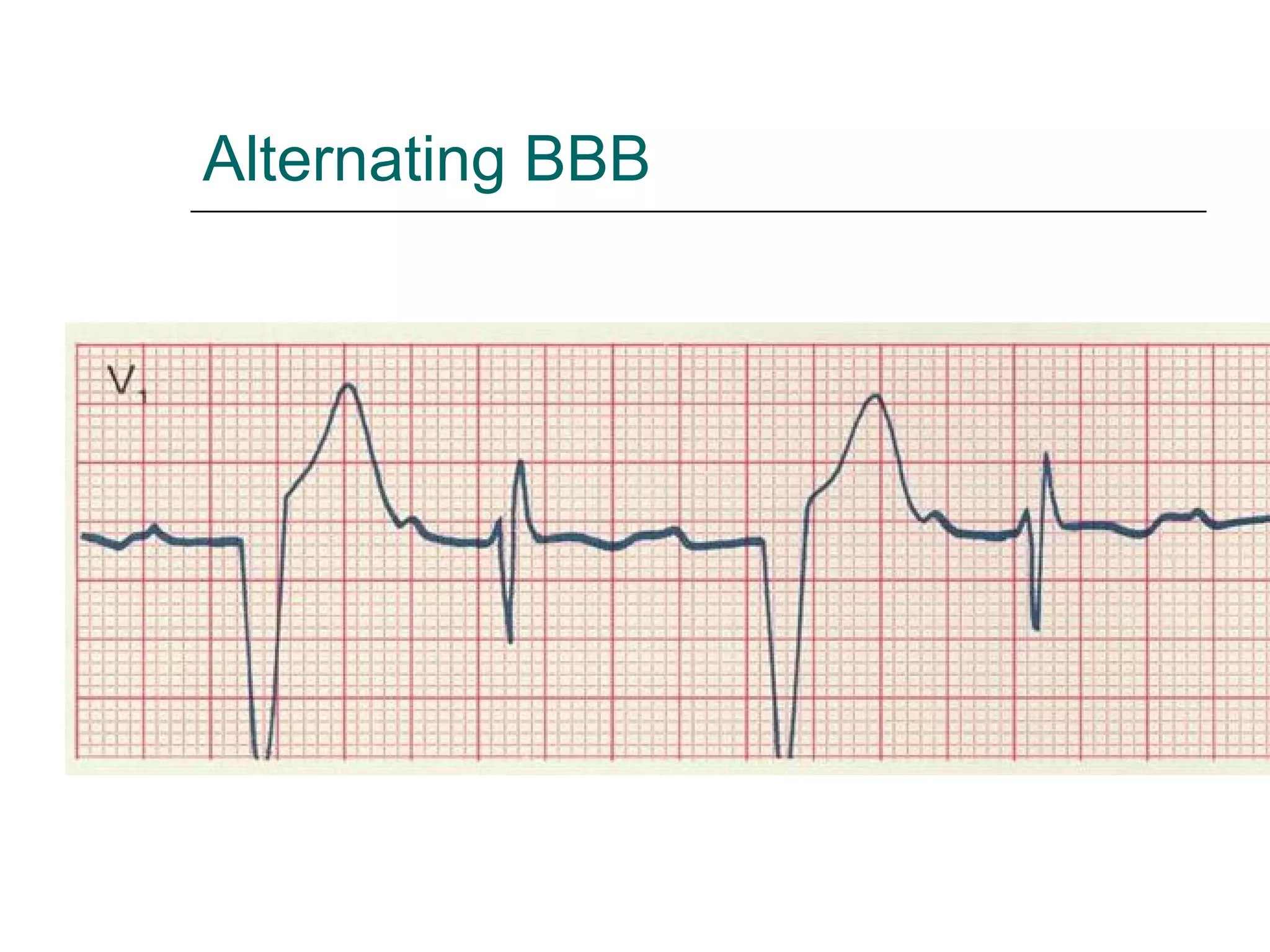 Alternating BBB 