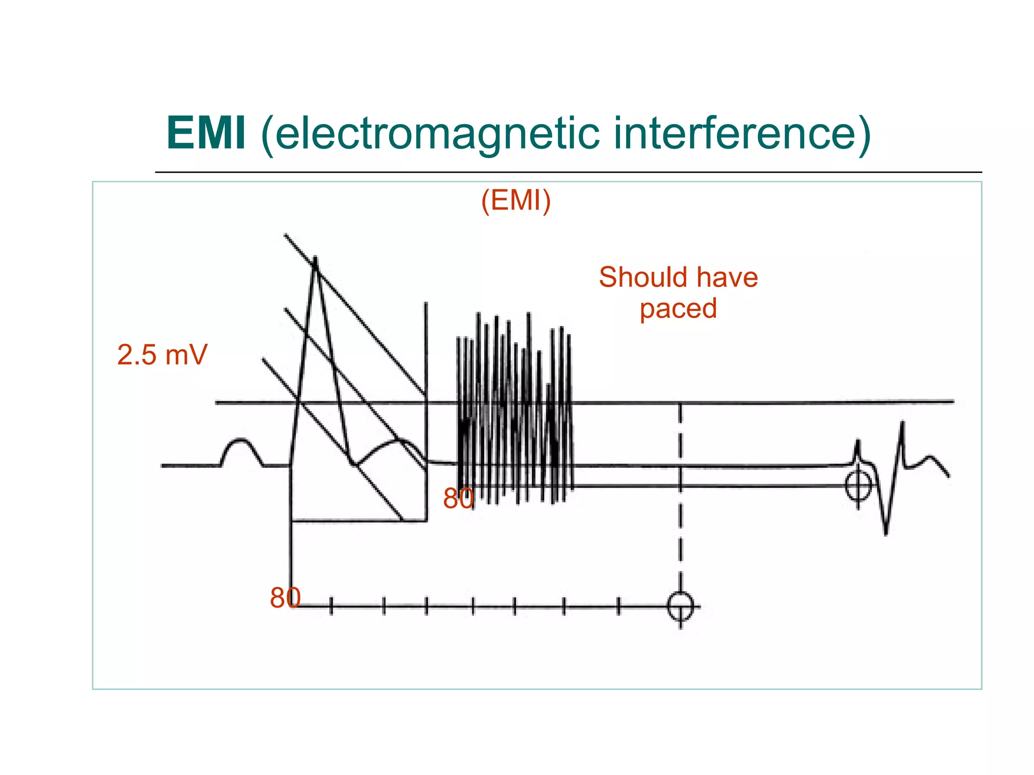 EMI  (electromagnetic interference) (EMI) 2.5 mV Should have paced 80 80 
