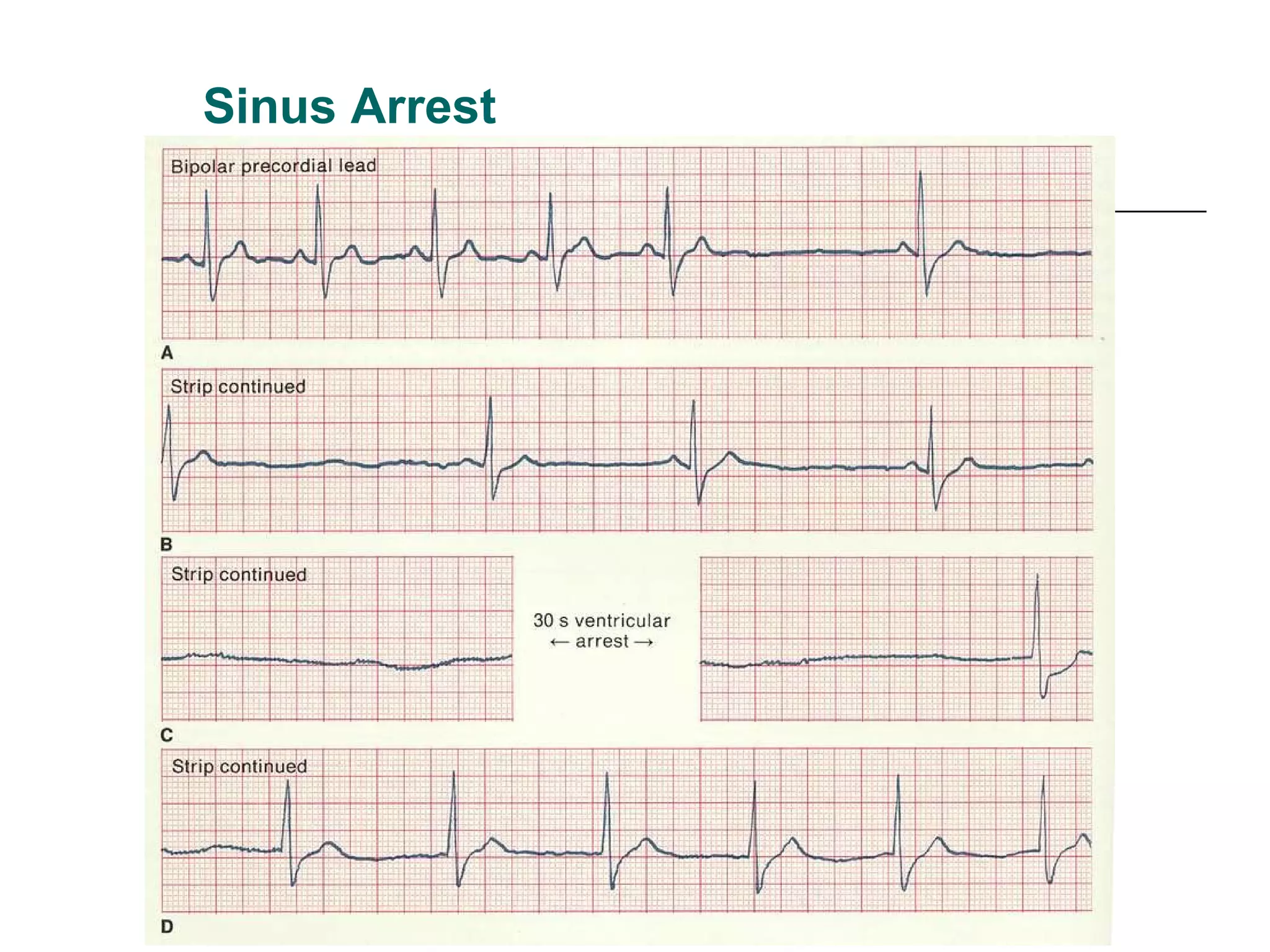 Sinus Arrest 
