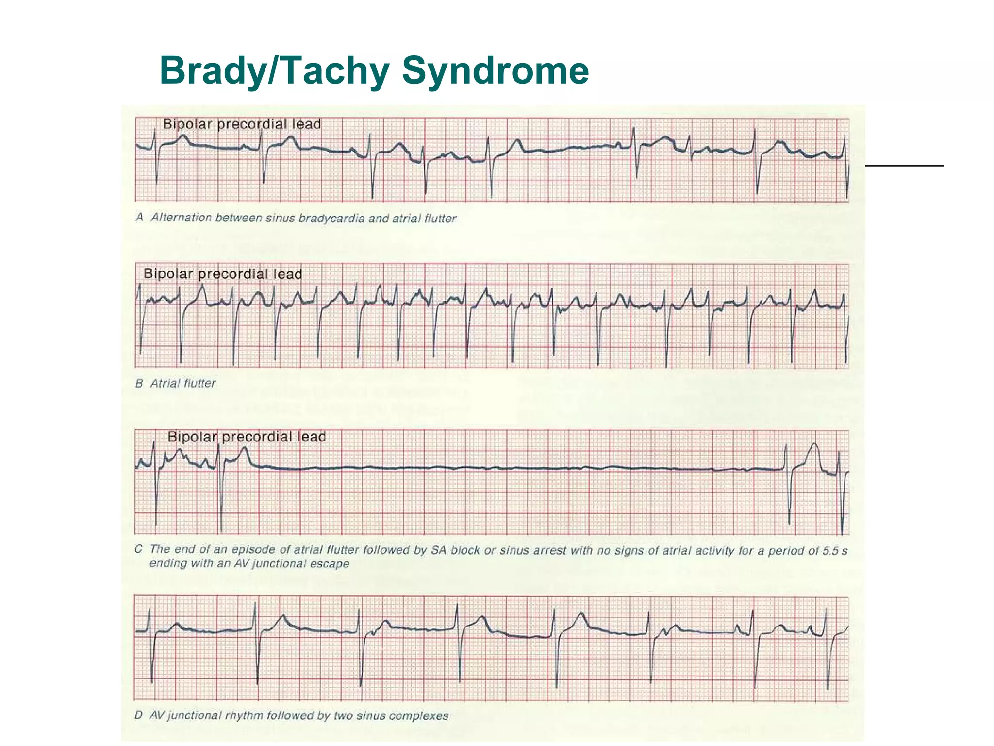 Brady/Tachy Syndrome 