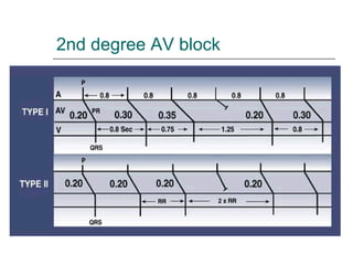 2nd degree AV block 