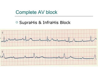Complete AV block SupraHis & InfraHis Block 