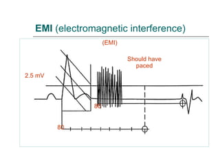 EMI  (electromagnetic interference) (EMI) 2.5 mV Should have paced 80 80 