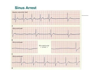 Sinus Arrest 