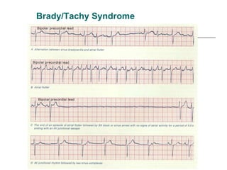 Brady/Tachy Syndrome 