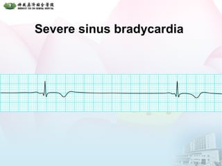 Severe sinus bradycardia
 
