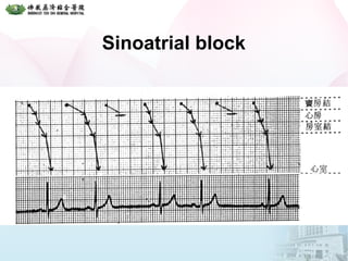 Sinoatrial block
 