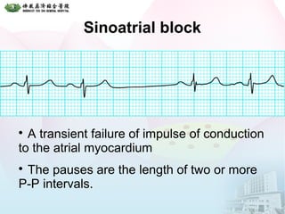 Sinoatrial block

A transient failure of impulse of conduction
to the atrial myocardium

The pauses are the length of two or more
P-P intervals.
 
