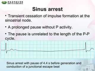 Sinus arrest
Sinus arrest with pause of 4.4 s before generation and
conduction of a junctional escape beat

Transient cessation of impulse formation at the
sinoatrial node.

A prolonged pause without P activity.

The pause is unrelated to the length of the P-P
cycle.
 