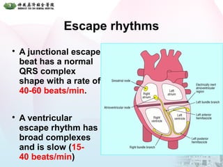 Escape rhythms

A junctional escape
beat has a normal
QRS complex
shape with a rate of
40-60 beats/min.

A ventricular
escape rhythm has
broad complexes
and is slow (15-
40 beats/min)
 