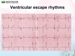 Ventricular escape rhythms
 