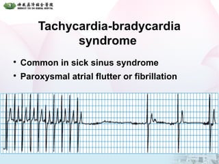 Tachycardia-bradycardia
syndrome

Common in sick sinus syndrome

Paroxysmal atrial flutter or fibrillation
 