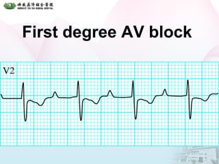 First degree AV block
 