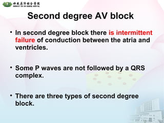 Second degree AV block

In second degree block there is intermittent
failure of conduction between the atria and
ventricles.

Some P waves are not followed by a QRS
complex.

There are three types of second degree
block.
 