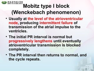 Mobitz type I block
(Wenckebach phenomenon)

Usually at the level of the atrioventricular
node, producing intermittent failure of
transmission of the atrial impulse to the
ventricles.

The initial PR interval is normal but
progressively lengthens until eventually
atrioventricular transmission is blocked
completely.

The PR interval then returns to normal, and
the cycle repeats.
 