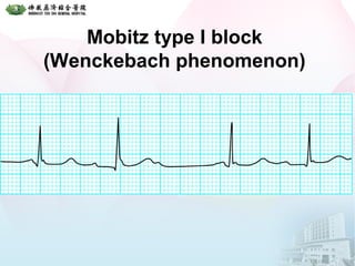 Mobitz type I block
(Wenckebach phenomenon)
 
