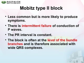 Mobitz type II block

Less common but is more likely to produce
symptoms.

There is intermittent failure of conduction of
P waves.

The PR interval is constant.

The block is often at the level of the bundle
branches and is therefore associated with
wide QRS complexes.
 