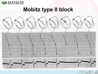 Mobitz type II block
 
