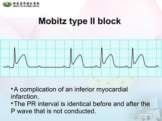 Mobitz type II block

A complication of an inferior myocardial
infarction.

The PR interval is identical before and after the
P wave that is not conducted.
 