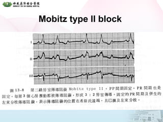 Mobitz type II block
 