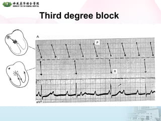 Third degree block
 