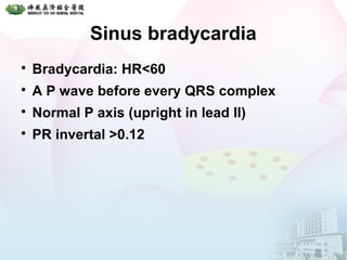 Sinus bradycardia

Bradycardia: HR<60

A P wave before every QRS complex

Normal P axis (upright in lead II)

PR invertal >0.12
 
