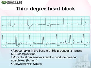 Third degree heart block

A pacemaker in the bundle of His produces a narrow
QRS complex (top)

More distal pacemakers tend to produce broader
complexes (bottom).

Arrows show P waves
 
