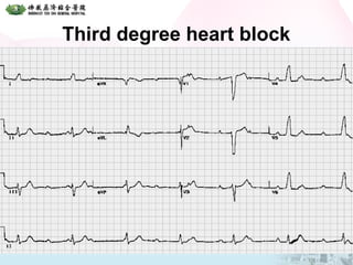 Third degree heart block
 