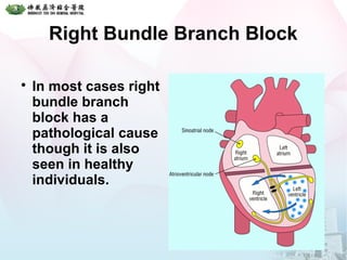 Right Bundle Branch Block

In most cases right
bundle branch
block has a
pathological cause
though it is also
seen in healthy
individuals.
 