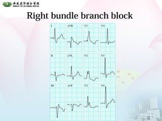 Right bundle branch block
 