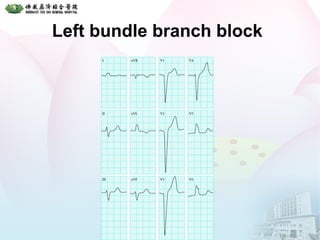 Left bundle branch block
 