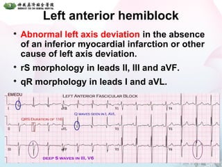 Left anterior hemiblock

Abnormal left axis deviation in the absence
of an inferior myocardial infarction or other
cause of left axis deviation.

rS morphology in leads II, III and aVF.

qR morphology in leads I and aVL.
56
 