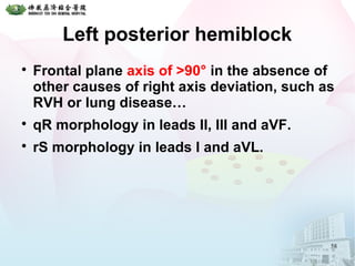 Left posterior hemiblock

Frontal plane axis of >90° in the absence of
other causes of right axis deviation, such as
RVH or lung disease…

qR morphology in leads II, III and aVF.

rS morphology in leads I and aVL.
58
 