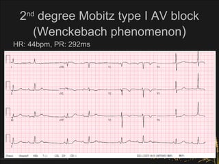 Arrhythmia :ECG-Bradycardia_20120909_中區 | PPT