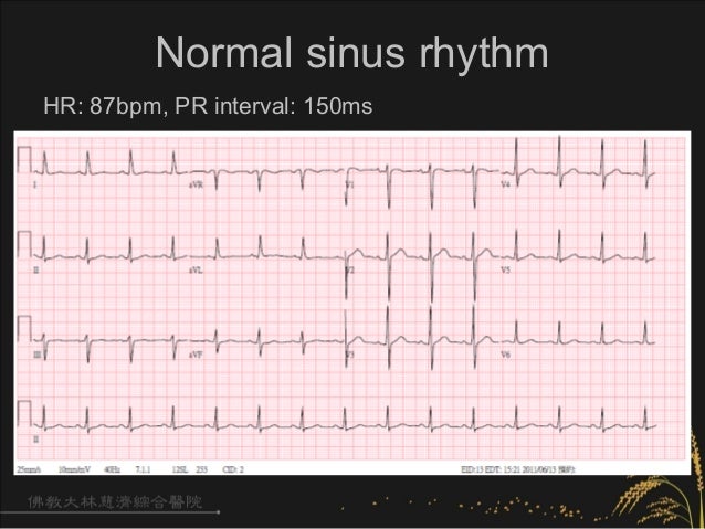 Arrhythmia Ecg Bradycardia 1909 中區 Arrhythmia Ecg Bradycardia 1909 中區