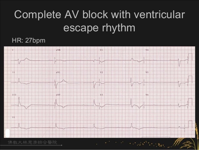 heart test e beat Arrhythmia 20120909 ä¸å :ECG Bradycardia heart test e beat Arrhythmia 20120909 ä¸å :ECG Bradycardia
