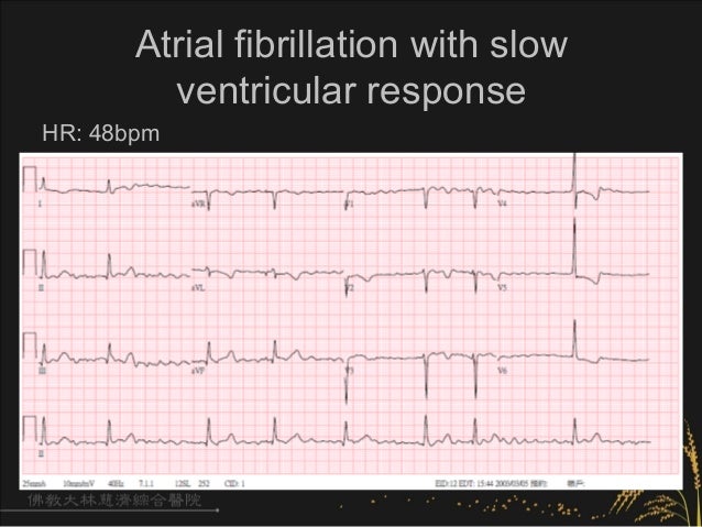 Afib Rvr Hr 230 What Is Atrial Fibrillation With Slow Ventricular Response? – YYHN