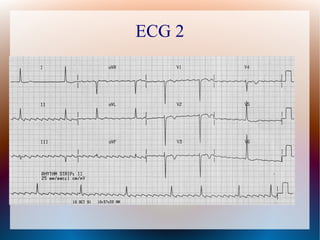 ECG 2
 