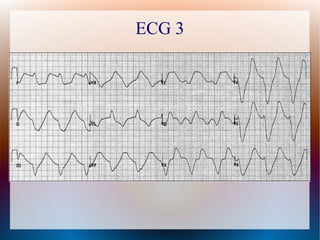 ECG 3
 