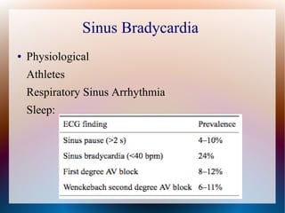 Sinus Bradycardia
● Physiological
Athletes
Respiratory Sinus Arrhythmia
Sleep:
 